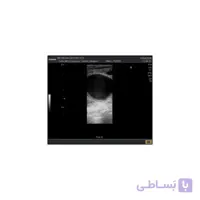 کاهش نویز Speckle در تصاویر سونوگرافی در MATLAB