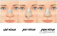 چسب لیفت بینی
