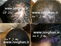 پک ضد ریزش مو