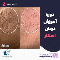 دوره آنلاین آموزش درمان اسکار