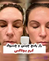 کرم ضد چین چروک و سفت کننده بوتاکس ایجلس