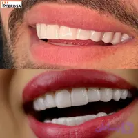 لمینت دندان دو فک مدل TruSmile به همراه نوار چسب سفیدکننده دندان