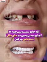 لمینت دندان snap on smile برای خرابی 4 دندان شرکت وردسا