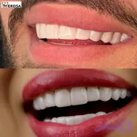 لمینت دندان اصلی آلمانی برای خرابی 4 دندان به همراه عینک دودی ویژه هدیه