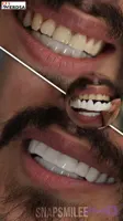 لمینت دندان snap on smile برای خرابی 2 دندان شرکت وردسا