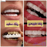 اسنپ آن اسمایل دندان فک بالا و پایین با مشاوره رایگان