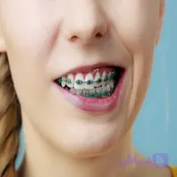 موم ارتودنسی آمیدن مدل Rxt حجم 3 میلی لیتر