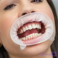 دهان بازکن اپتراگیت ایوکلار Optra Gate 3D Lip Retractor